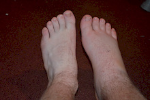 guess which one is broken?? lol lots of swelling from a broken fibula